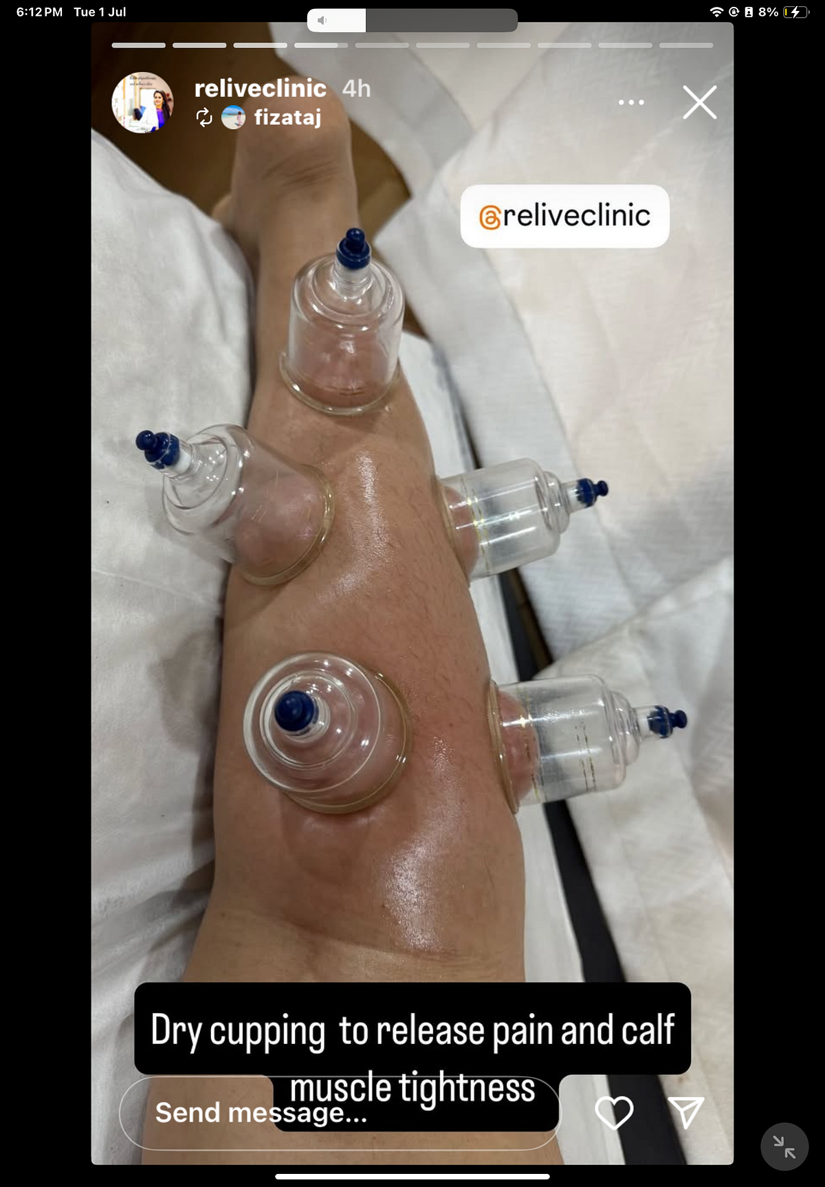 Pic of me doing cupping in physiotherapy